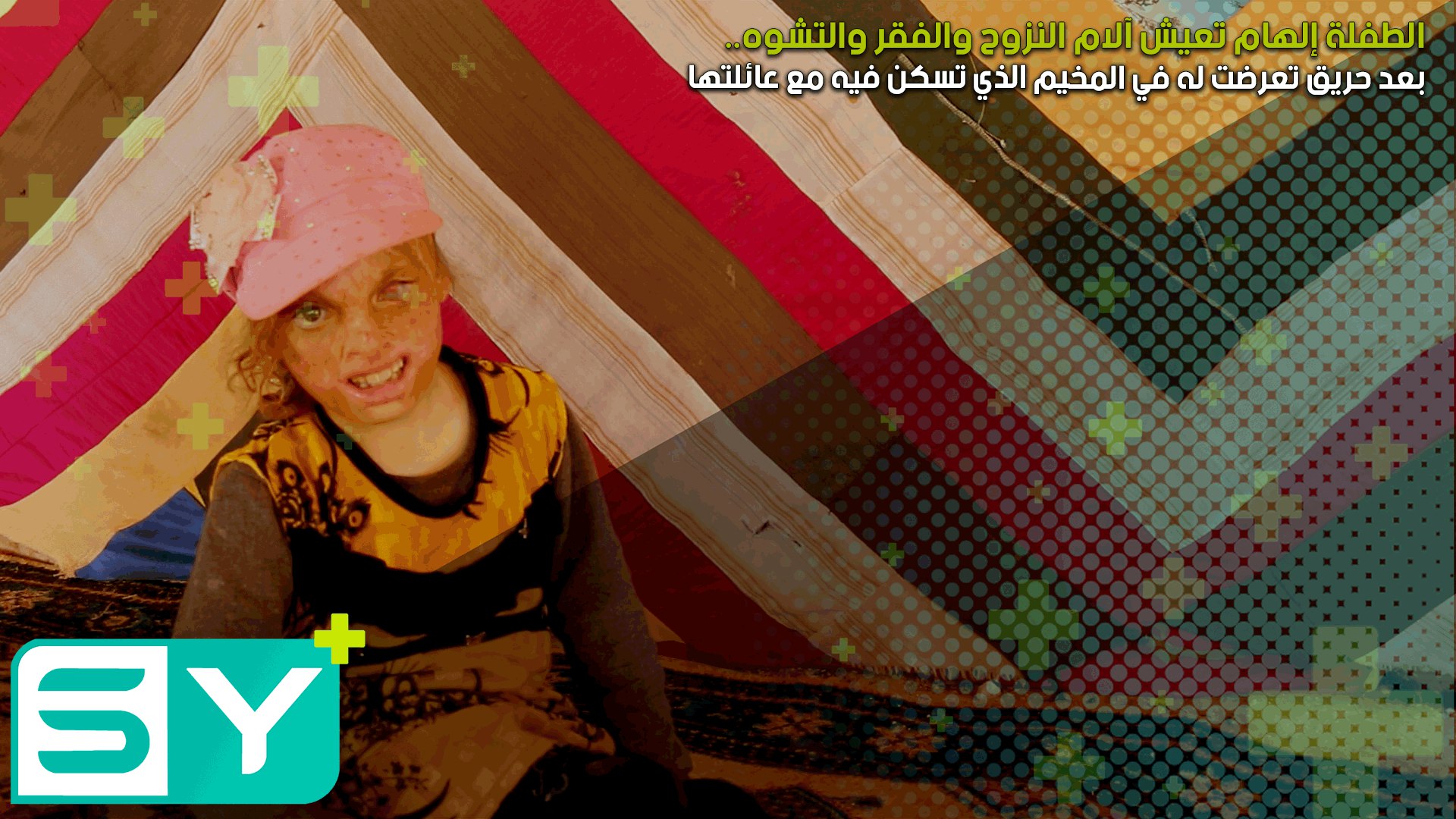 الطفلة إلهام تعيش آلام النزوح والفقر والتشوه بعد حريق تعرضت له في المخيم الذي تسكن فيه مع عائلتها