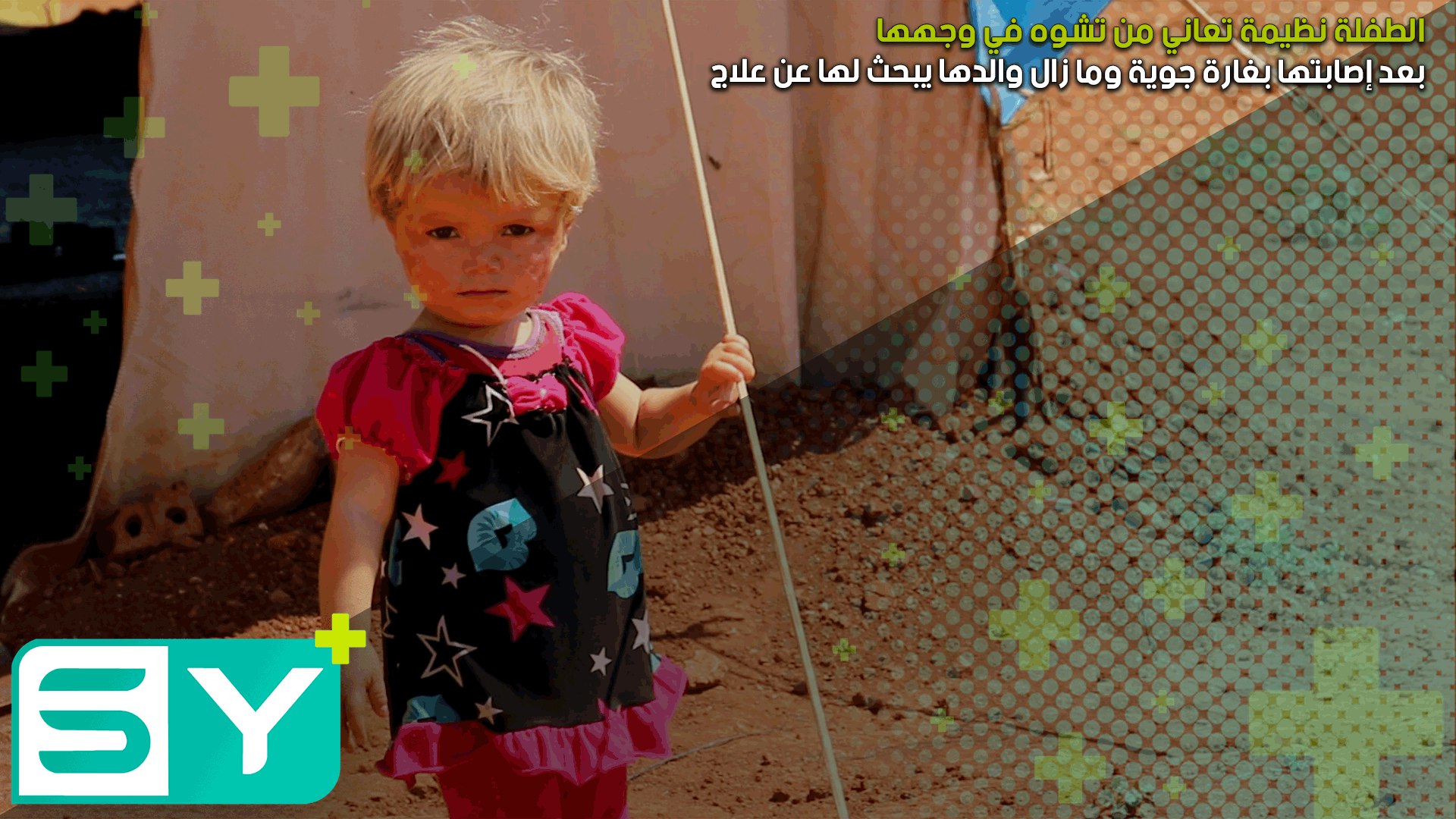 الطفلة نظيمة تعاني من تشوه في وجهها بعد إصابتها بغارة جوية وما زال والدها يبحث لها عن علاج