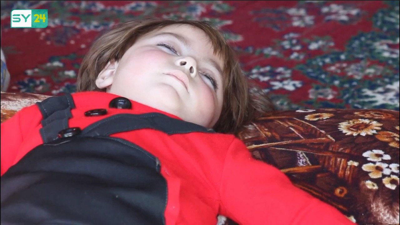 زواج الأقارب يحرم طفلة من الحركة في إدلب