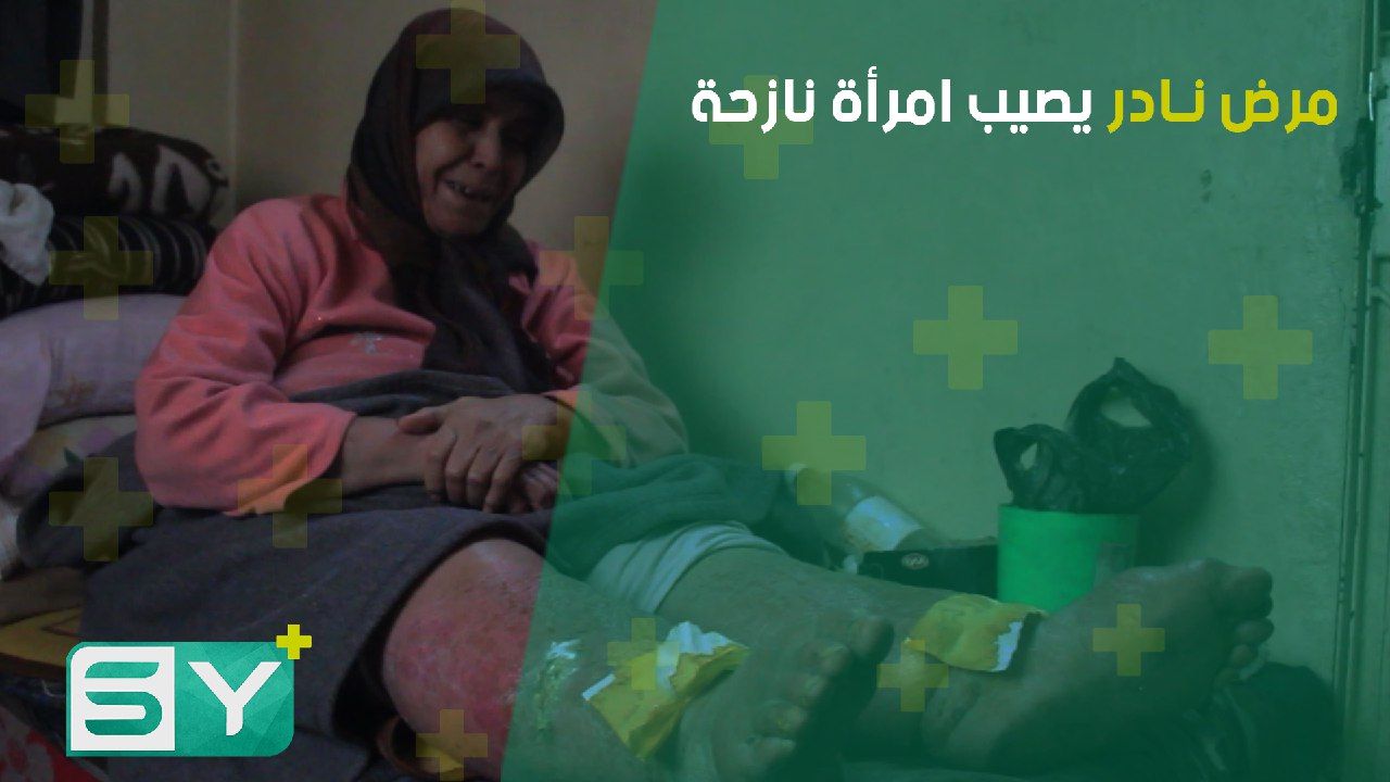 داء الفيل.. مرض نادر يصيب امرأة نازحة من ريف اللاذقية