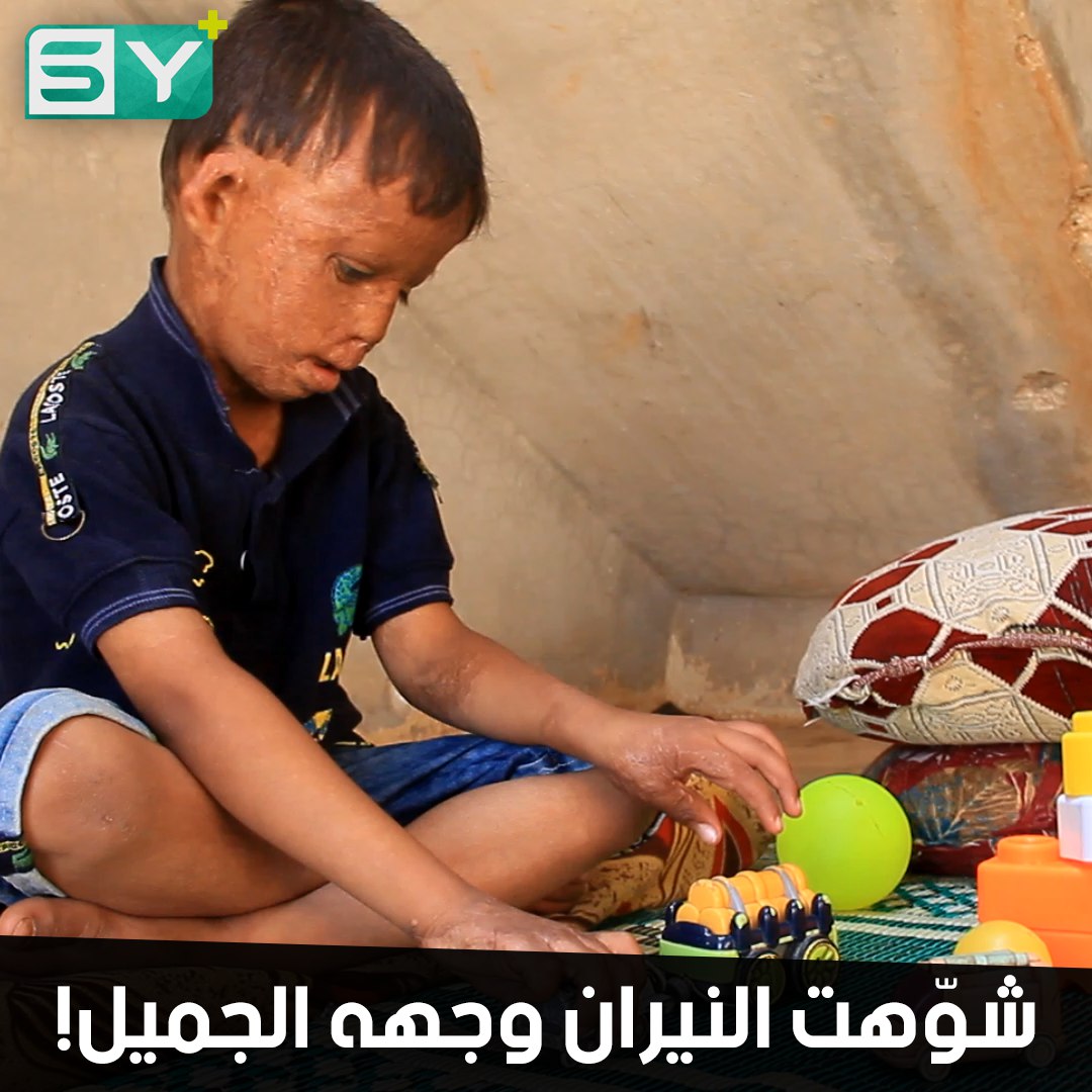 ياسر طفل نازح تعرض لحروق في وجهه.. يحتاج لعلاج لتعود ابتسامته من جديد