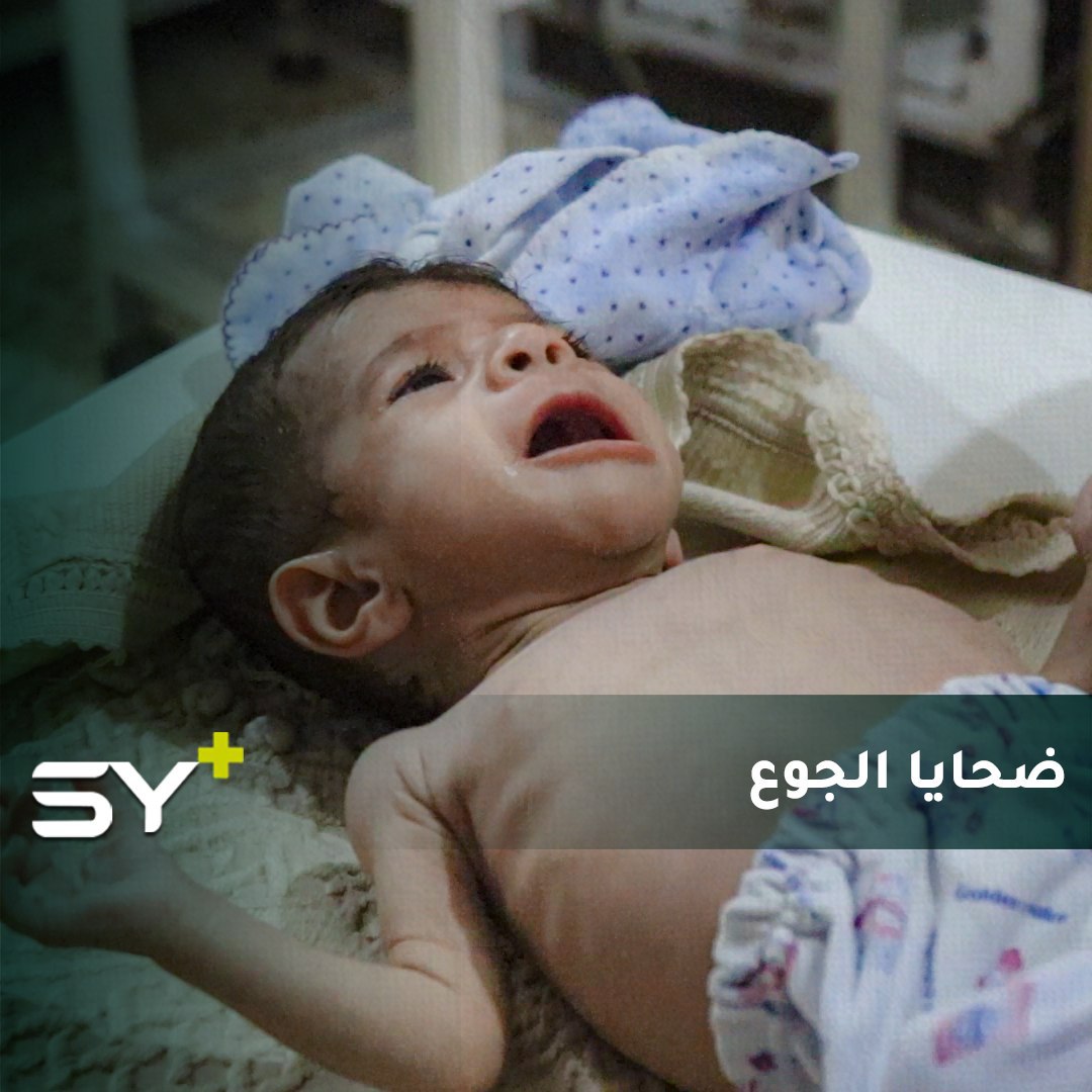 سوء التغذية.. معاناة الأطفال في مخيمات النزوح شمال إدلب