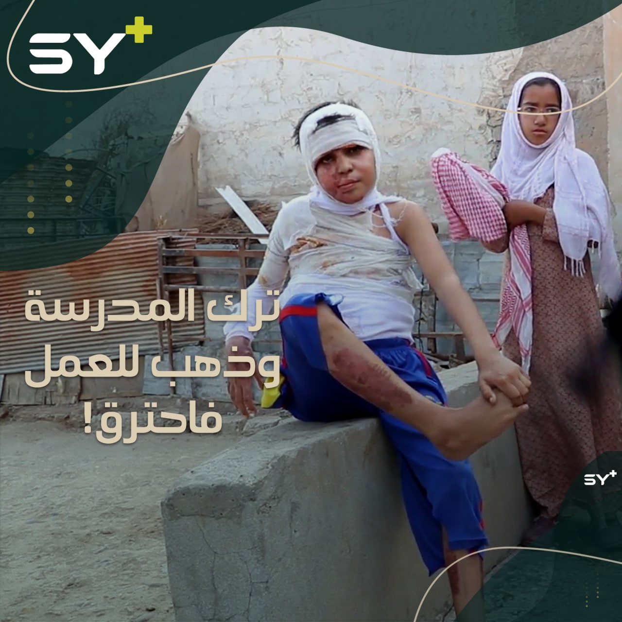 يعملون بأعمال لا تناسب أعمارهم فتقع الكارثة.. خالد طفل تعرض لحروق بليغة في أول يوم عمل له!