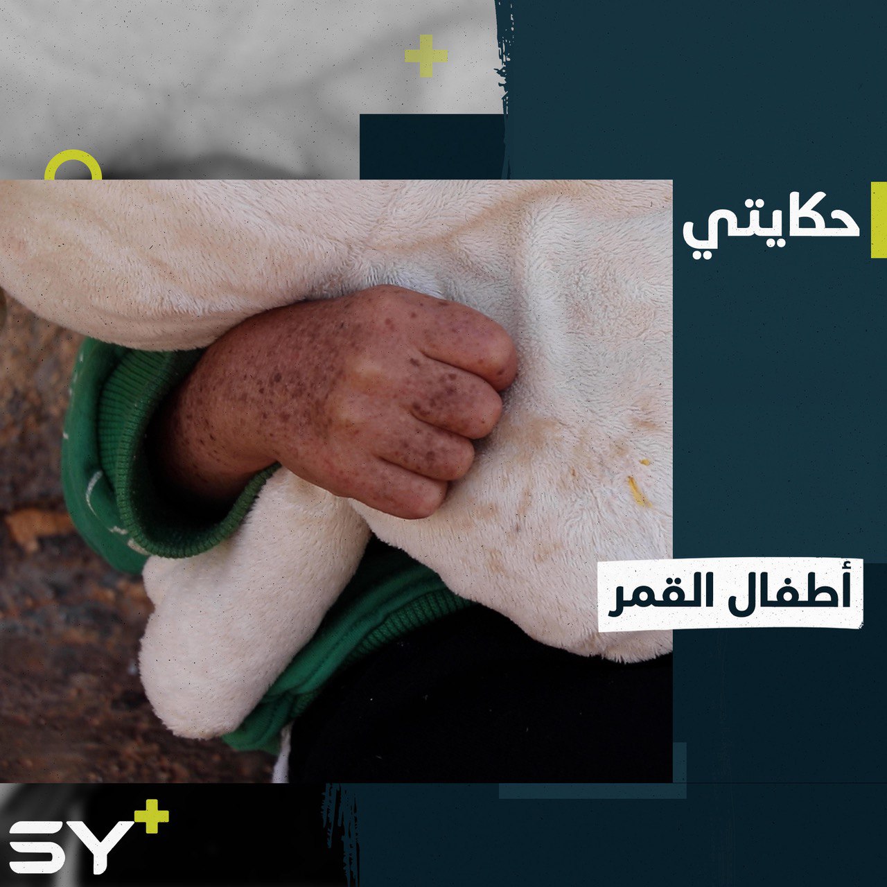 أطفال القمر أعداء الضوء.. ماذا تعرفون عن هذا المرض؟