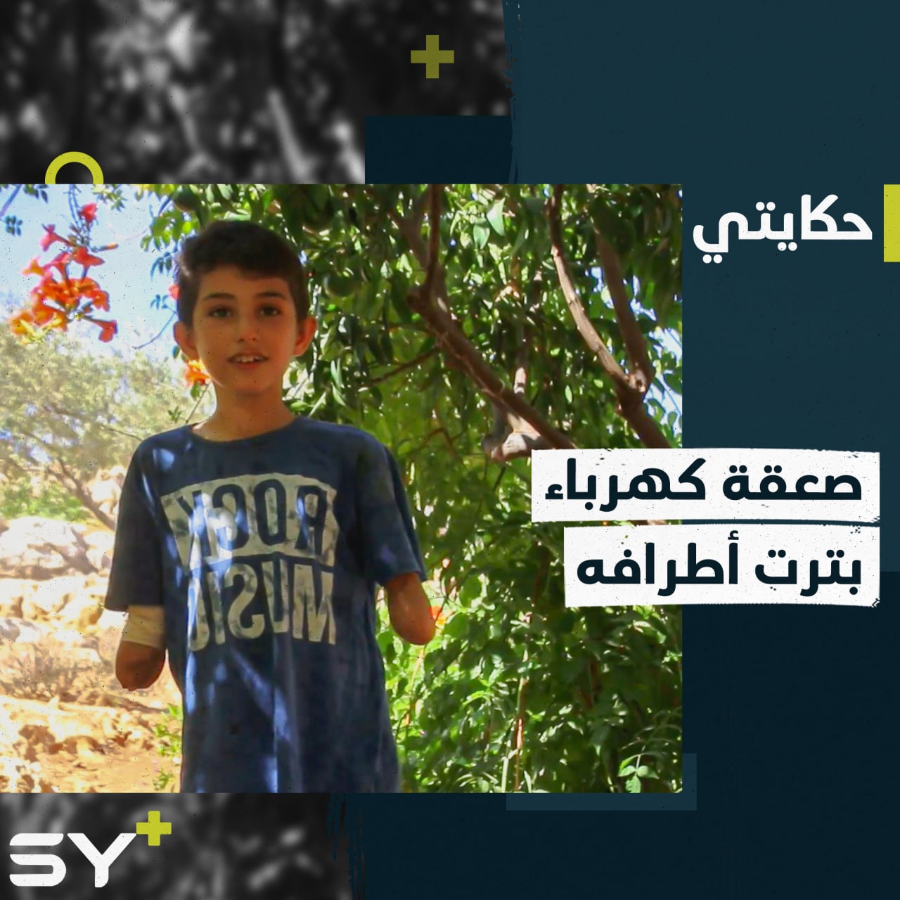 “الحياة مو كويسة بدون يدين”.. معتصم طفل فقد أطرافه بصعقة كهرباء