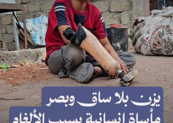 6 سنوات والمعاناة مستمرة.. يزن طفل فقد بصره وساقه بانفجار لغم في دير الزور